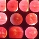 Choroiditis Choroiditis